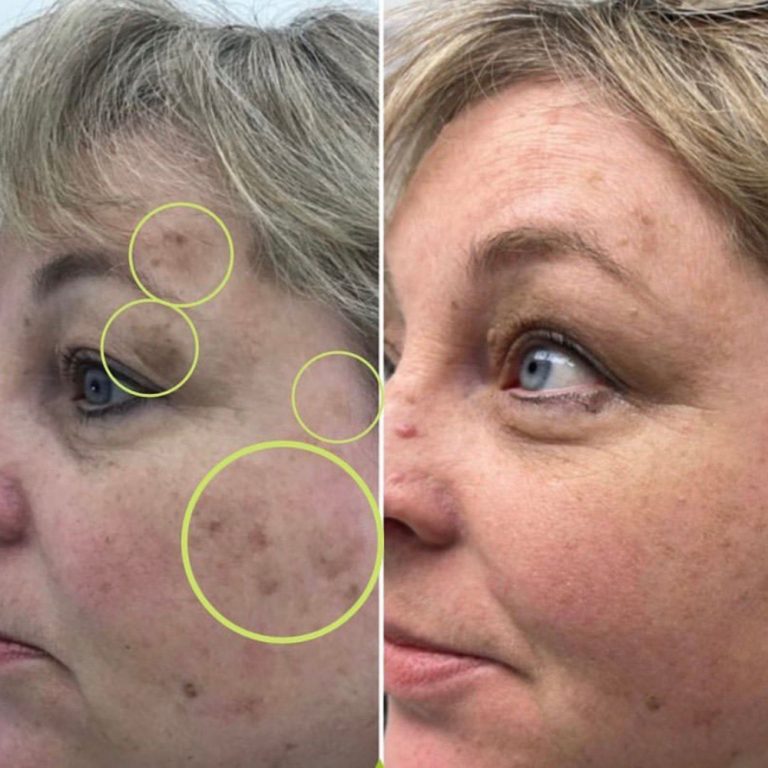 Cryopen before and after results for pigmentation treatment at Aesthetics of Essex