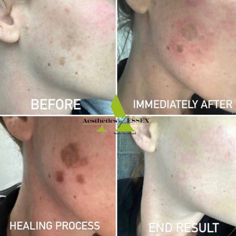 Cryopen before and after results for pigmentation treatment at Aesthetics of Essex
