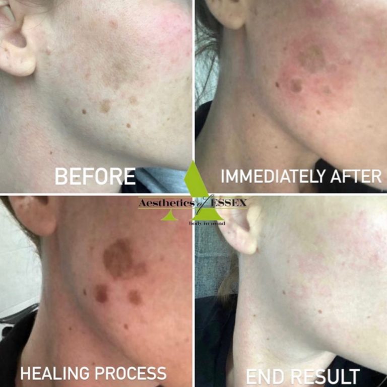 Cryopen before and after results for pigmentation treatment at Aesthetics of Essex