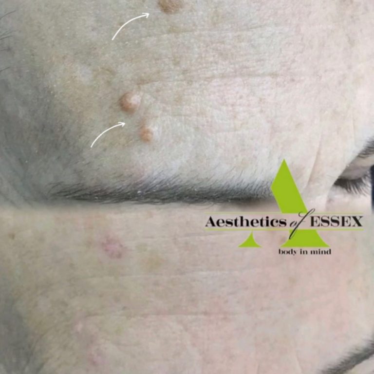 Cryopen before and after results for lesion removal at Aesthetics of Essex