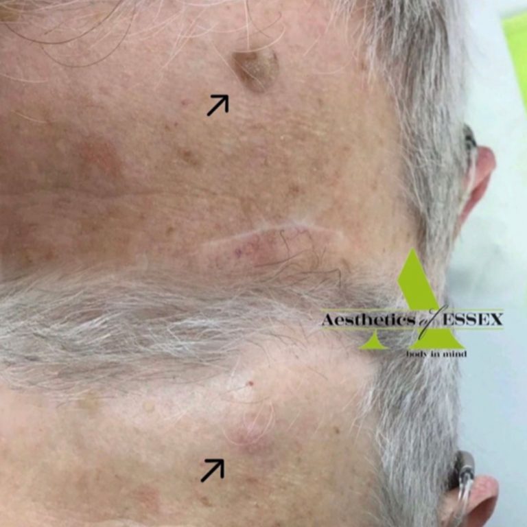 Cryopen before and after results for seborrhoeic keratosis treatment at Aesthetics of Essex