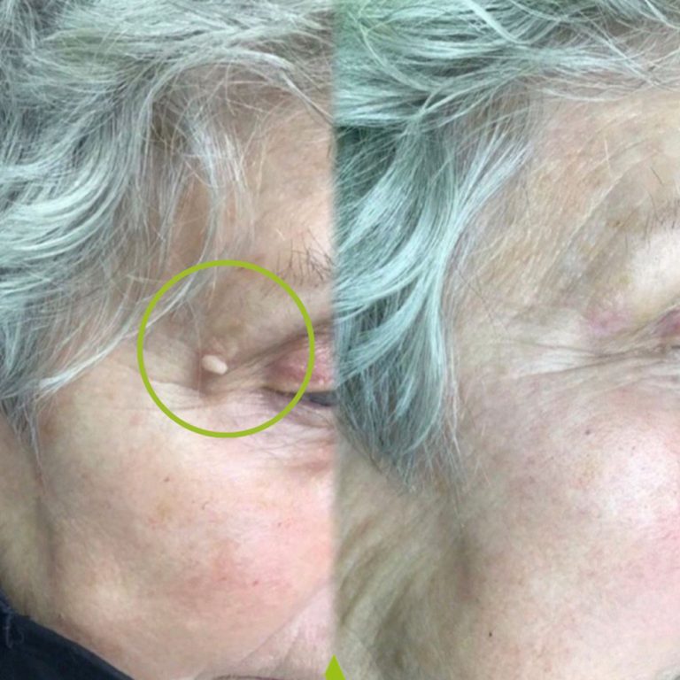 Cryopen before and after results for skin tag removal at Aesthetics of Essex