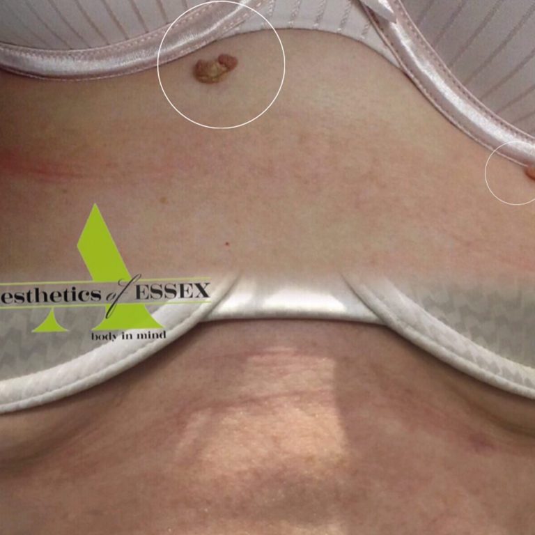 Cryopen before and after results for skin tag removal at Aesthetics of Essex
