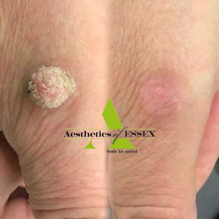 Cryopen before and after results for wart removal at Aesthetics of Essex