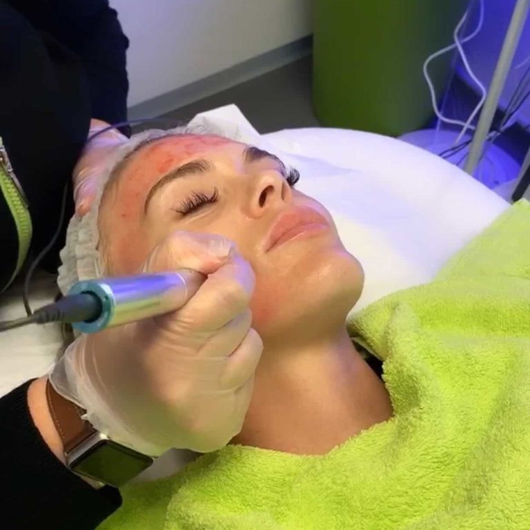 Dermapen microneedling treatment in progress at Aesthetics of Essex