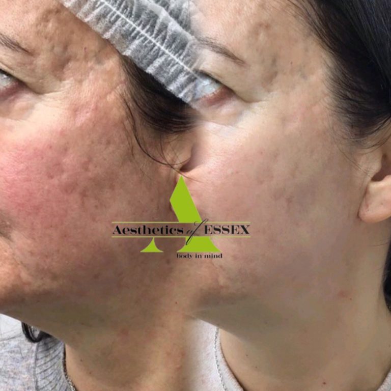 Dermapen before and after results at Aesthetics of Essex