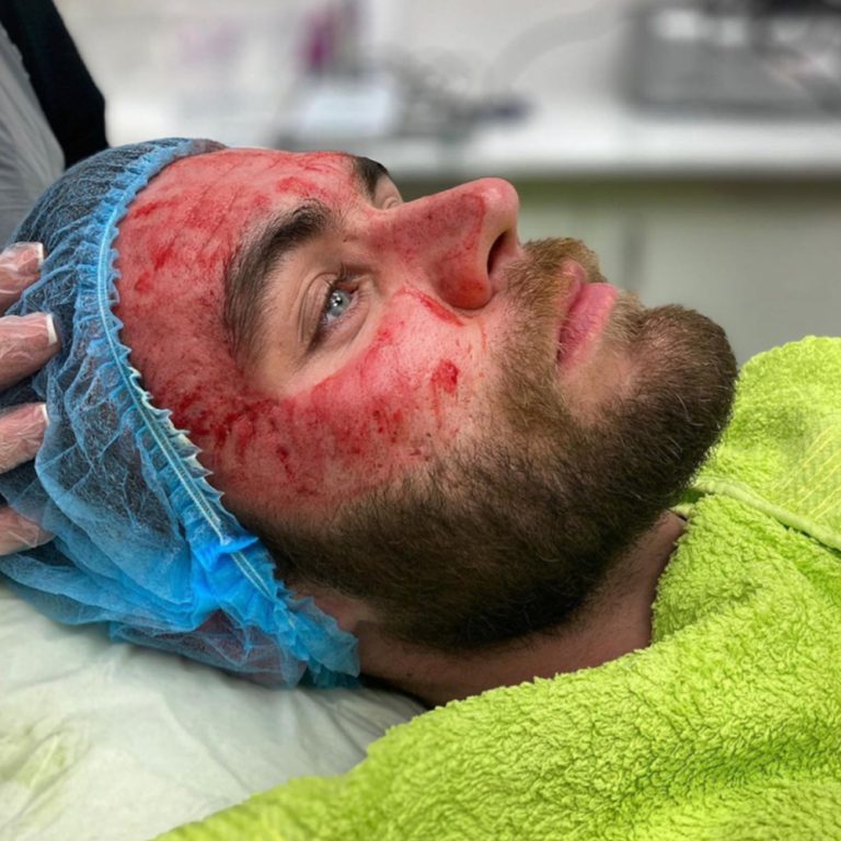Dermapen before and after results at Aesthetics of Essex