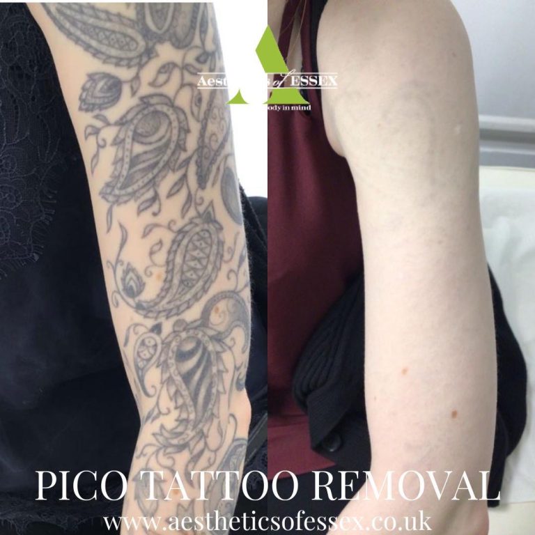 picosure