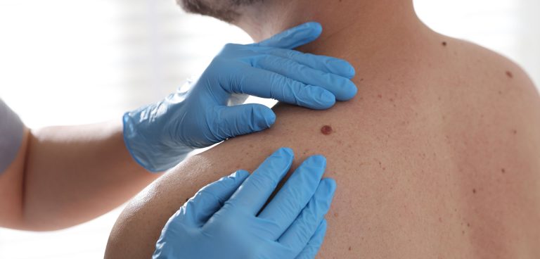 Skin Tags