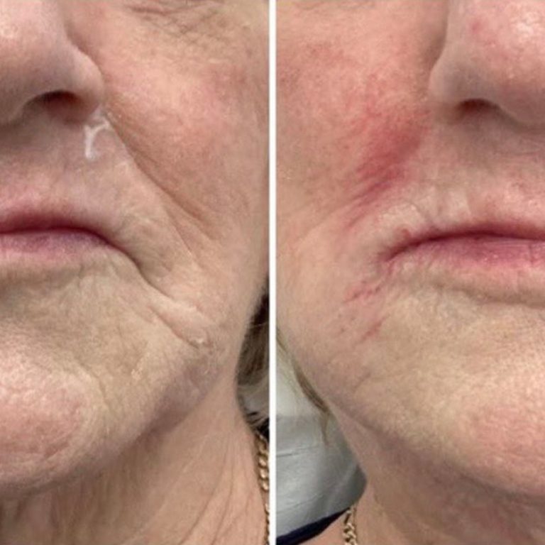Dermal Filler before and after results at Aesthetics of Essex