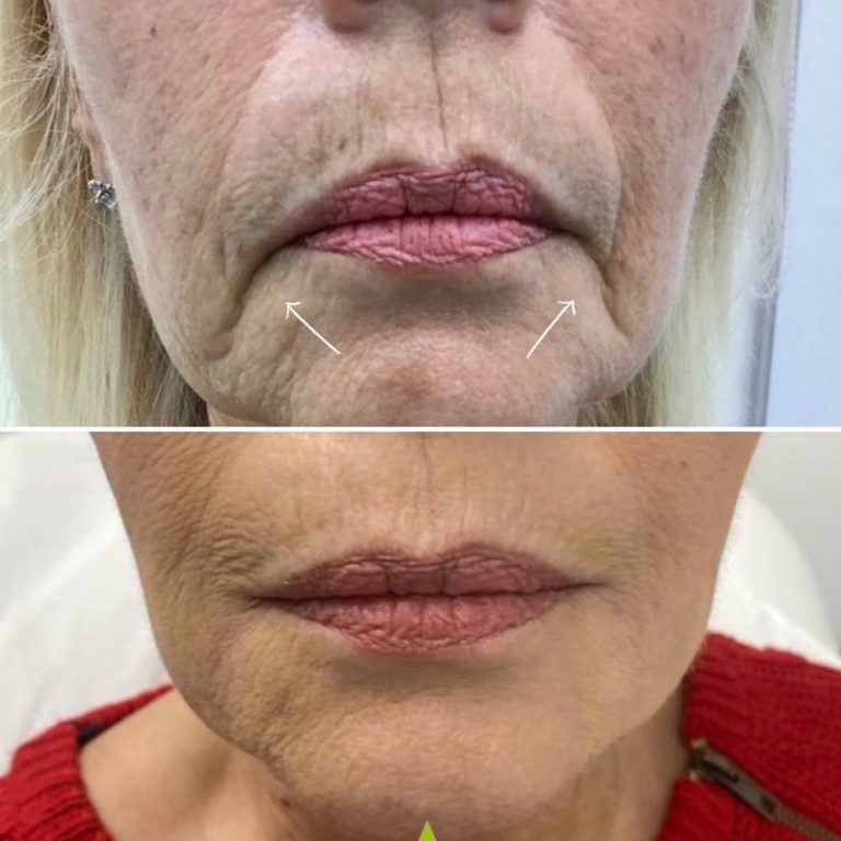 Dermal Filler before and after results at Aesthetics of Essex