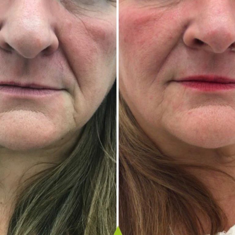 Dermal Filler before and after results at Aesthetics of Essex
