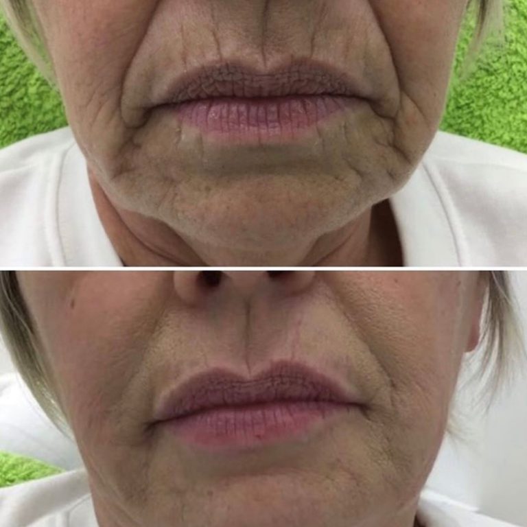 Dermal Filler before and after results at Aesthetics of Essex