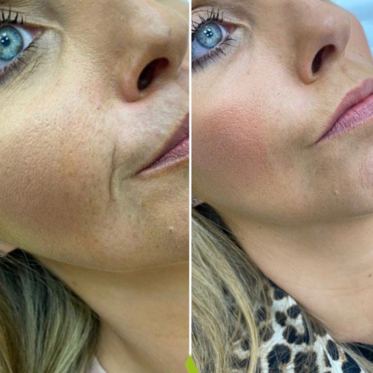 Dermal Filler before and after results at Aesthetics of Essex
