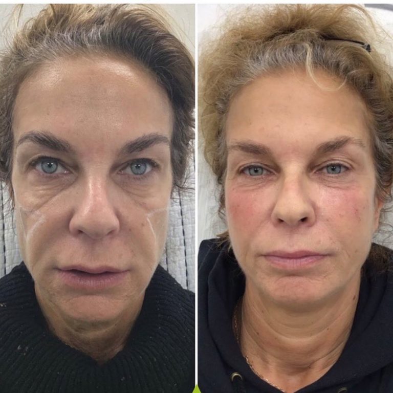 Dermal Filler before and after results at Aesthetics of Essex