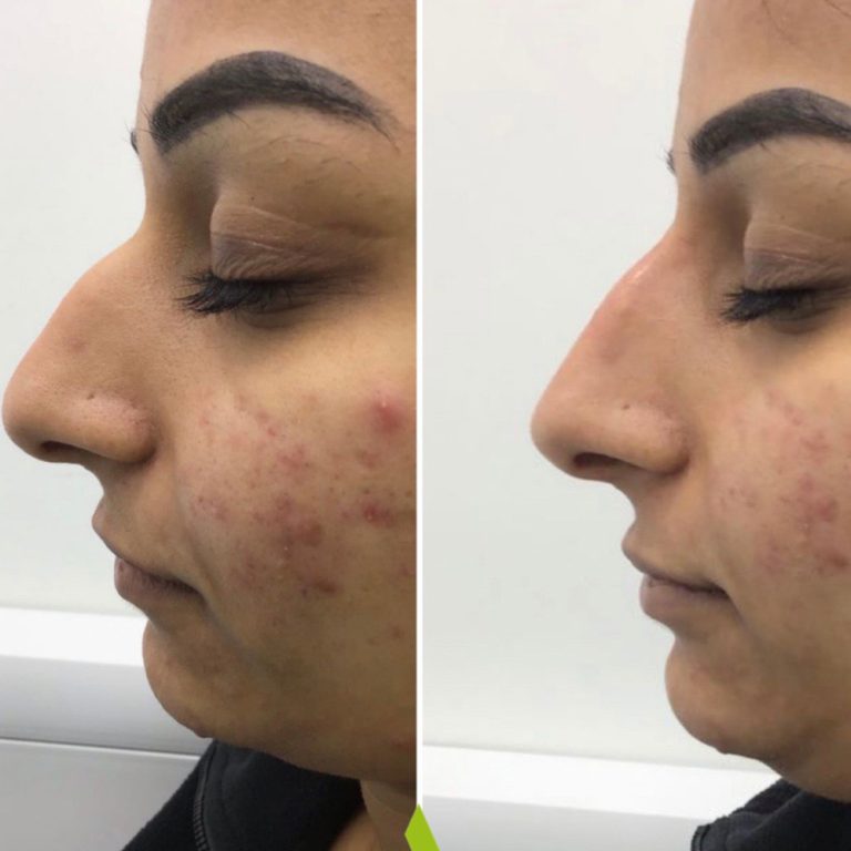 Dermal Filler before and after results at Aesthetics of Essex