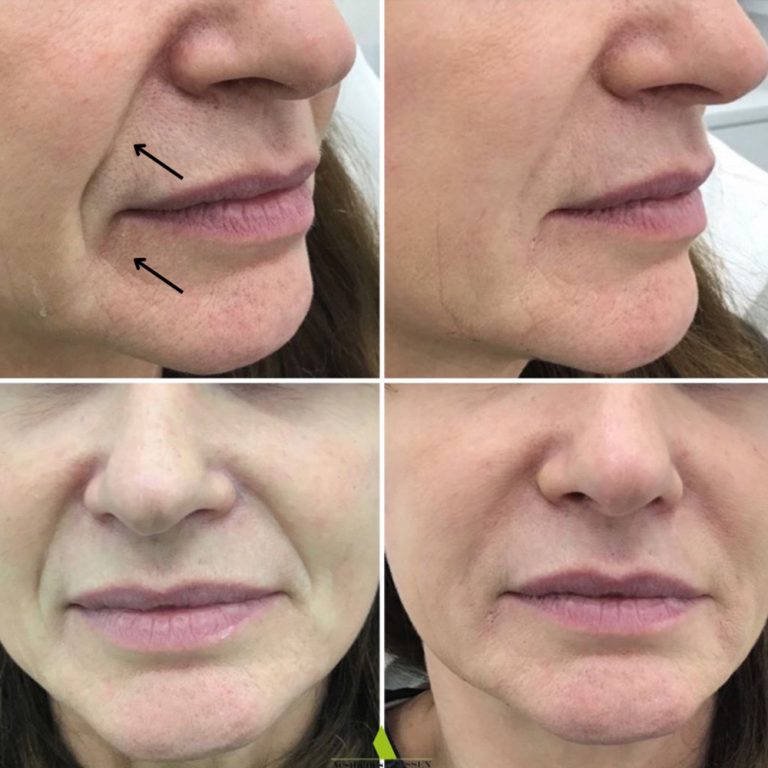 Dermal Filler before and after results at Aesthetics of Essex