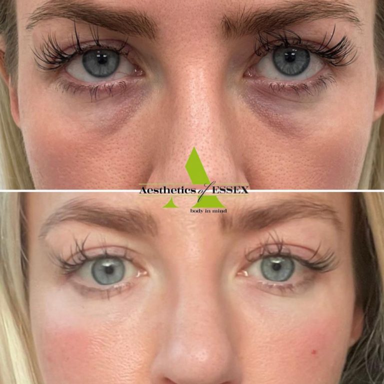 Dermal Filler before and after results at Aesthetics of Essex