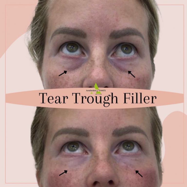 Dermal Filler before and after results at Aesthetics of Essex