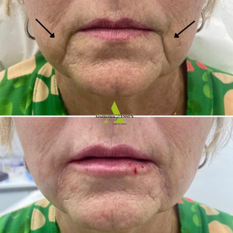 Dermal Filler before and after results at Aesthetics of Essex