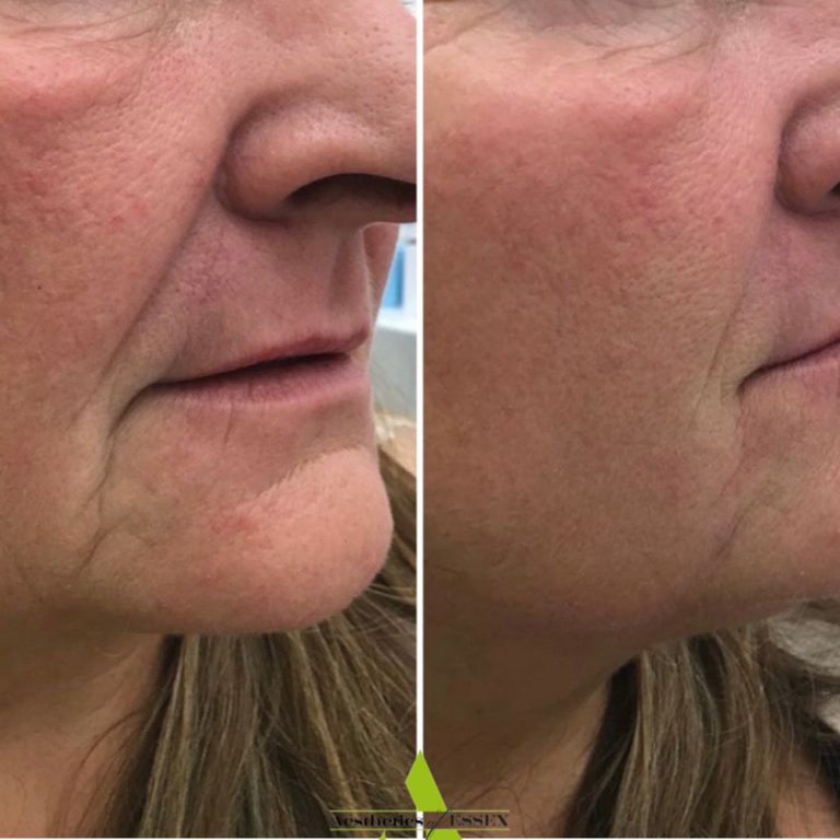 Dermal Filler before and after results at Aesthetics of Essex