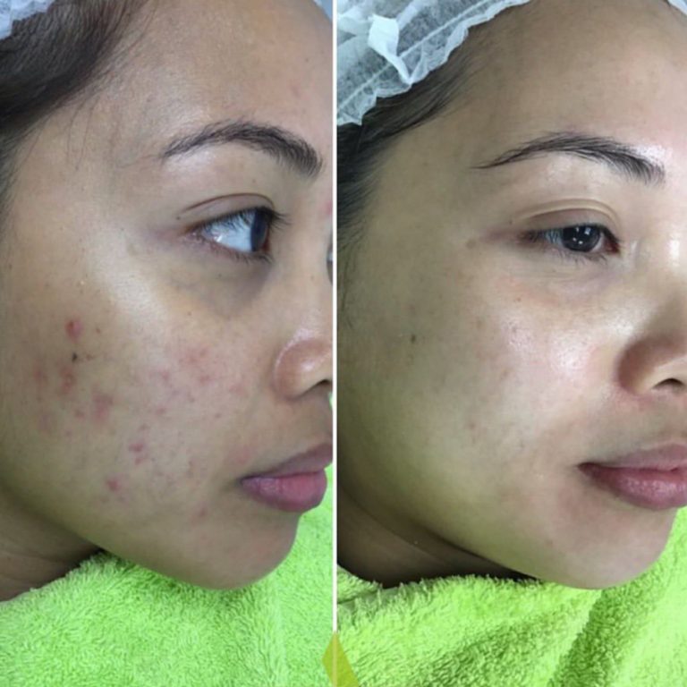 Dermapen before and after results at Aesthetics of Essex