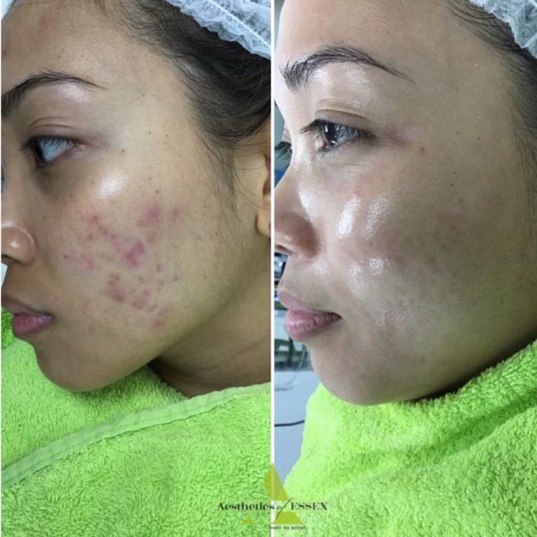 Dermapen before and after results at Aesthetics of Essex