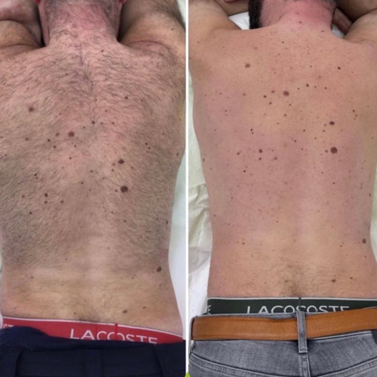 Laser Hair Removal before and after results at Aesthetics of Essex
