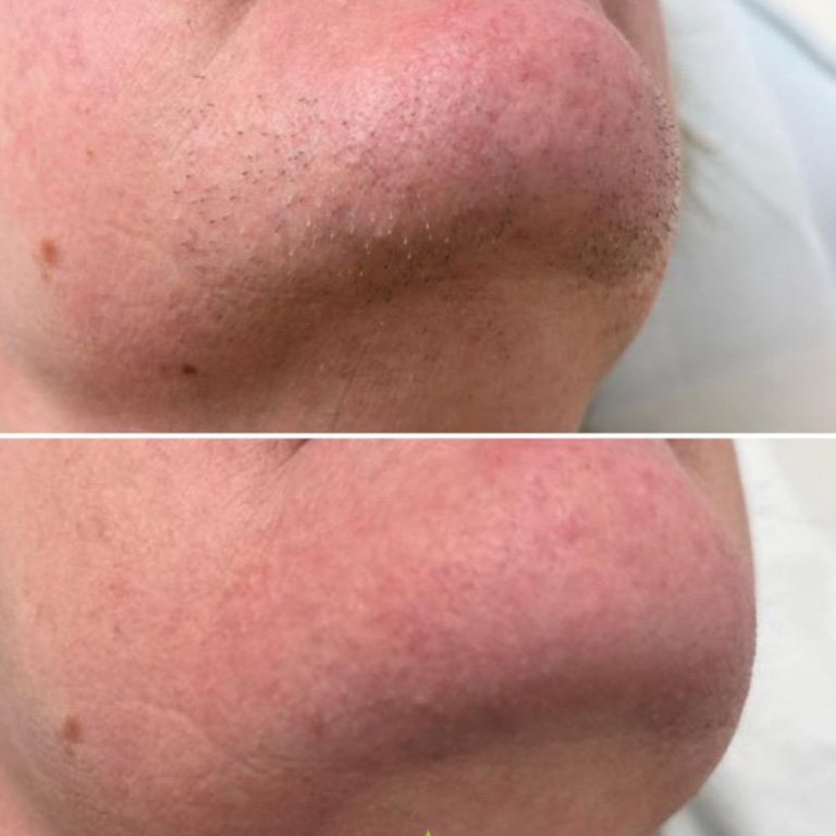 Laser Hair Removal before and after results at Aesthetics of Essex