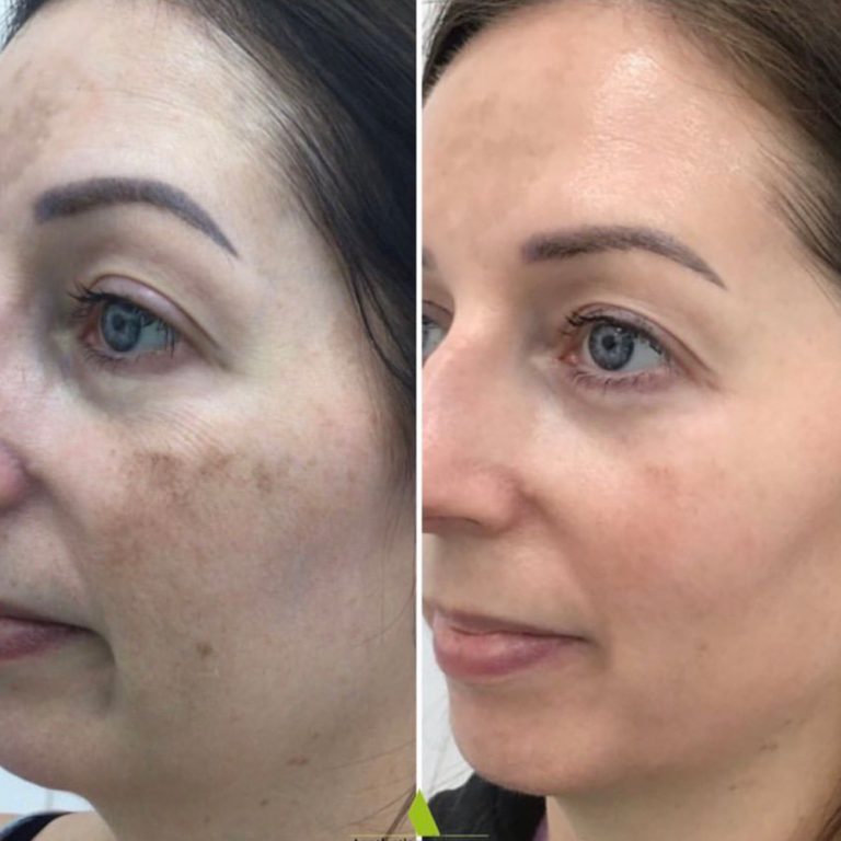 Laser Hair Removal before and after results at Aesthetics of Essex