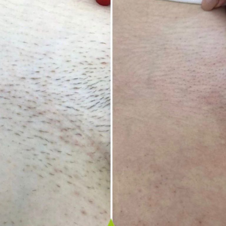 Laser Hair Removal before and after results at Aesthetics of Essex