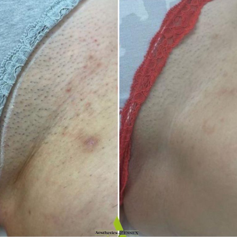 Laser Hair Removal before and after results at Aesthetics of Essex