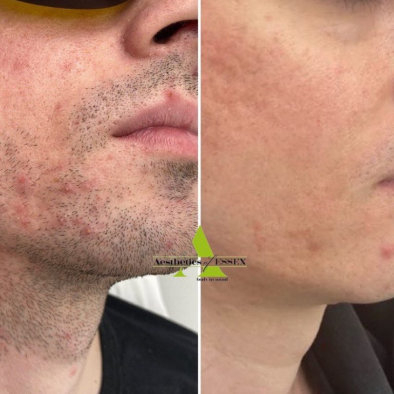 Laser Hair Removal before and after results at Aesthetics of Essex