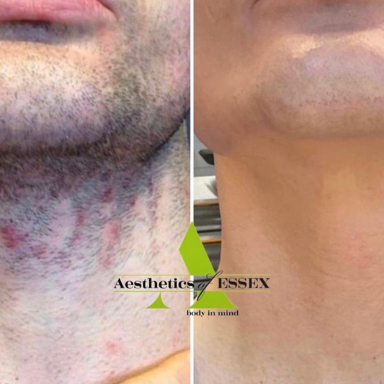 Laser Hair Removal before and after results at Aesthetics of Essex