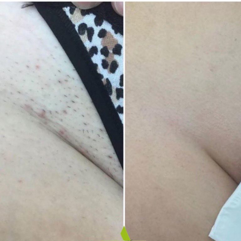Laser Hair Removal before and after results at Aesthetics of Essex