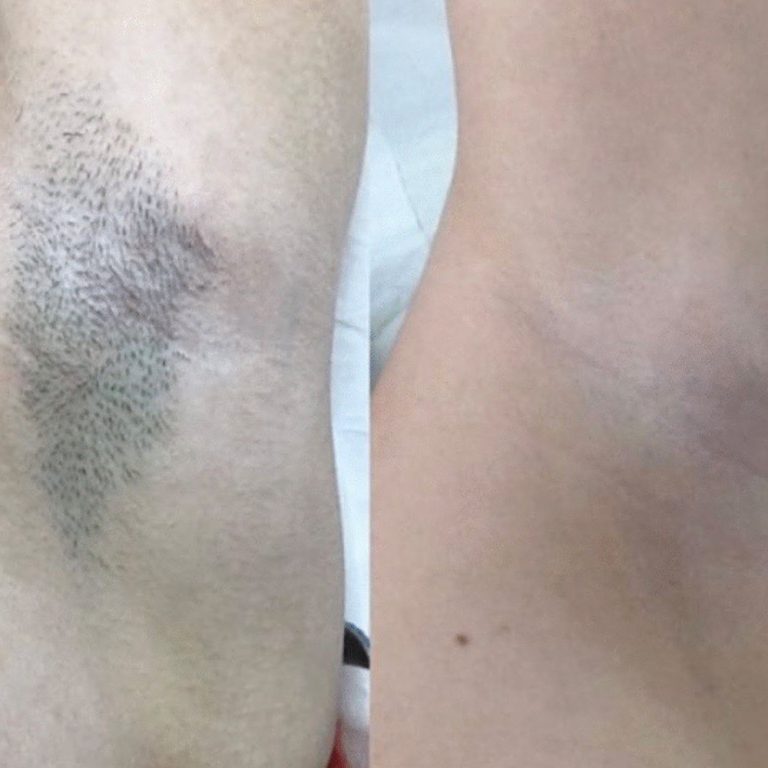 Laser Hair Removal before and after results at Aesthetics of Essex
