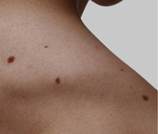 Moles on shoulder skin for mole removal treatment