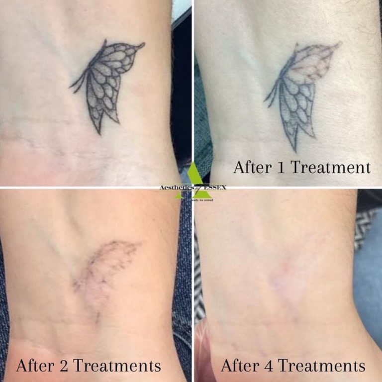 Picosure Tattoo Removal before and after results at Aesthetics of Essex