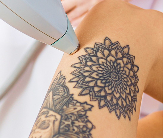 Picosure Tattoo Removal