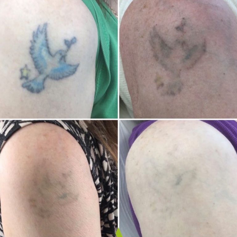 Picosure Tattoo Removal before and after results at Aesthetics of Essex