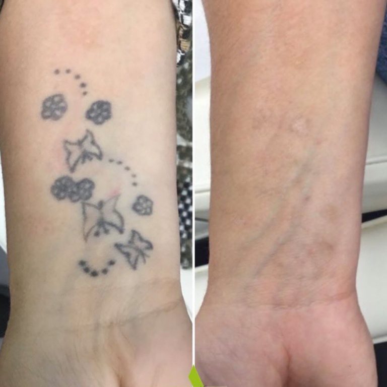 Picosure Tattoo Removal before and after results at Aesthetics of Essex