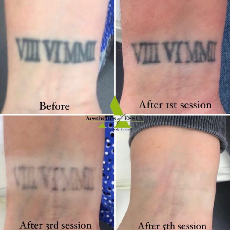 Picosure Tattoo Removal before and after results at Aesthetics of Essex