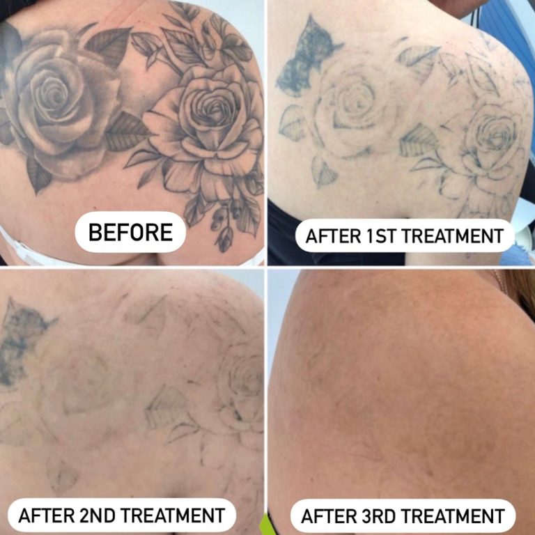 Picosure Tattoo Removal before and after results at Aesthetics of Essex