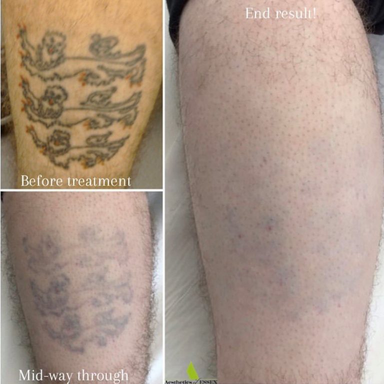 Picosure Tattoo Removal before and after results at Aesthetics of Essex