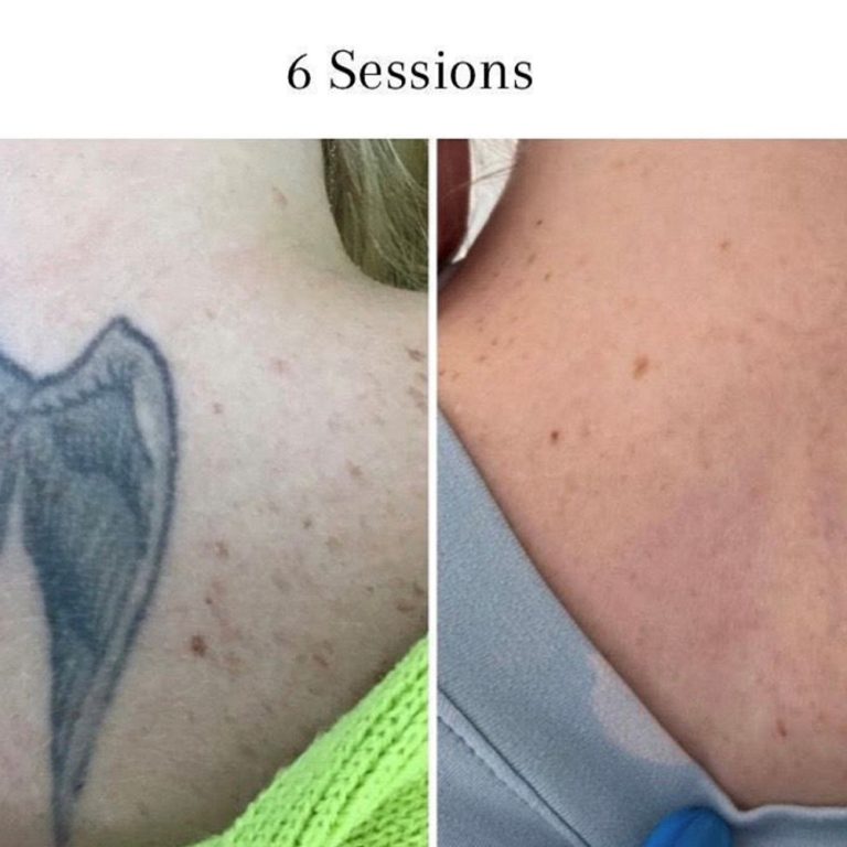 Picosure Tattoo Removal before and after results at Aesthetics of Essex