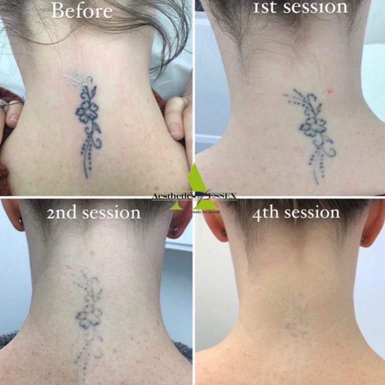 Picosure Tattoo Removal before and after results at Aesthetics of Essex