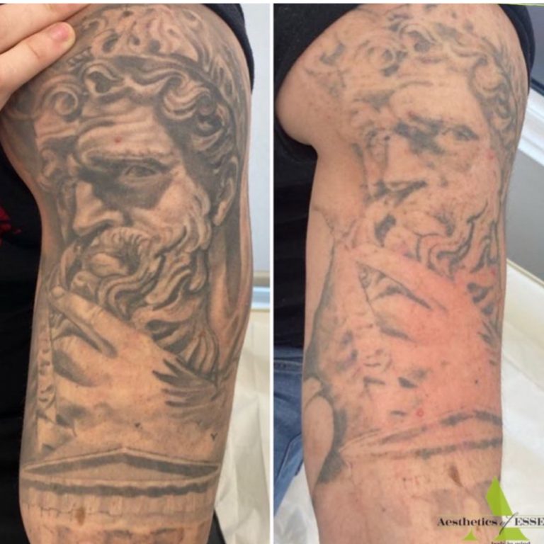 Picosure Tattoo Removal before and after results at Aesthetics of Essex