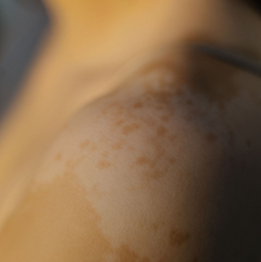 skin pigmentation