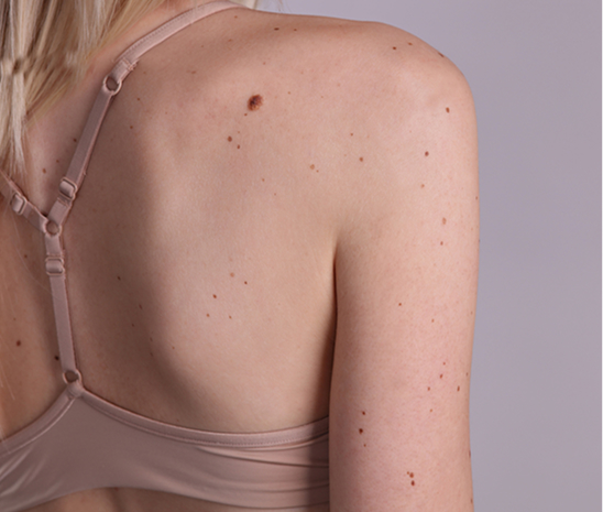 Skin lesions on back for skin tag and wart removal