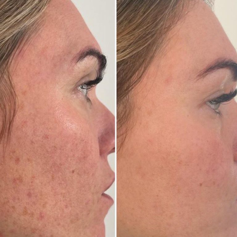 Skin Peels before and after results at Aesthetics of Essex